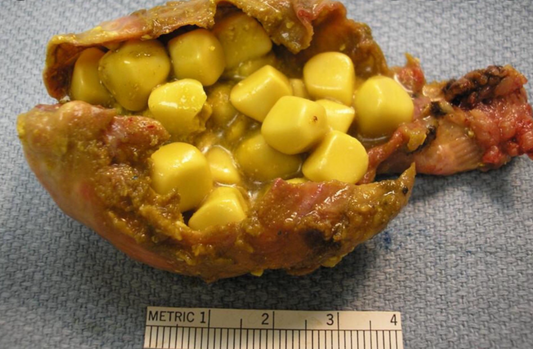 What Do You Know About Cholesterol Gallstones?